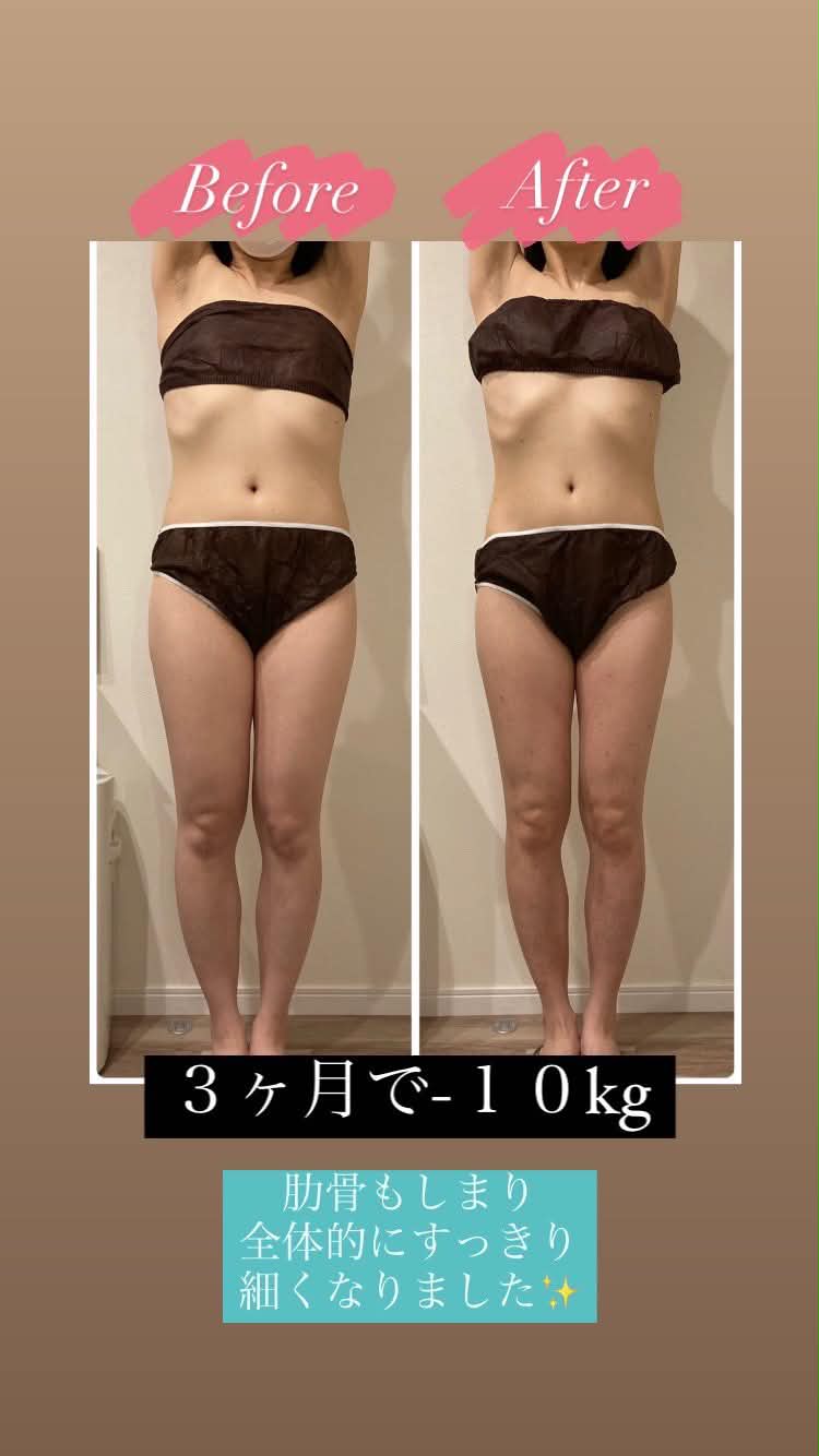 富士吉田市polloの痩身ダイエットサポート3か月の施術事例